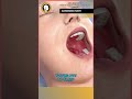 🚨 Enlarged Adenoids: A Hidden Danger! 🚨