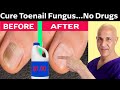 How to Cure Toenail Fungus for Pennies a Day!  Dr. Mandell