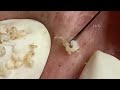 Satisfying Pimple Popping & Acne Removal ASMR 😌 | Deep Extraction Videos