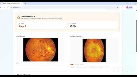 🔥 AI-Based DR Detection – Final Phase Completed 🚀