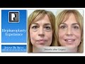 My personal experience of upper and lower blepharoplasty with Dr. Julian De Silva