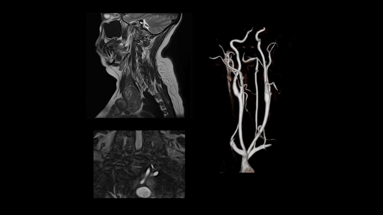 Time-Spatial Labeling Inversion Pulse (Time-SLIP) MRA