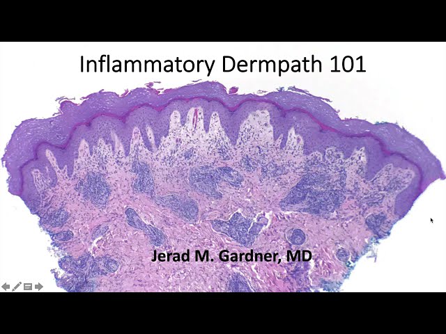 Inflammatory Dermpath 101 (A Beginner's Guide to Diagnosing Skin Rashes for Non-Dermatopathologists) class=