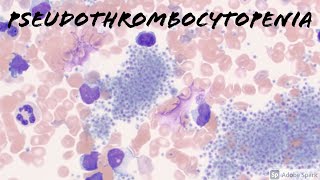 Why does this patient have Pseudothrombocytopenia? screenshot 5