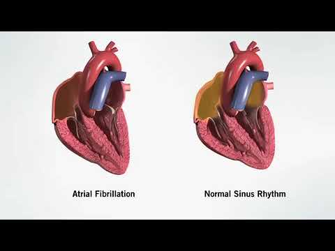 Atrial Fibrillation