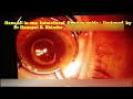 Hans Intravitreal guide designed by Dr. Hanspal S bhinder