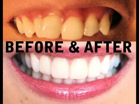 My TEETH (Before &amp; After) Invisalign, Zoom Teeth Whitening 