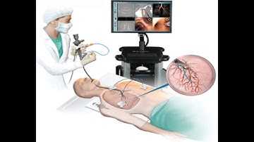 Bronchoscopy with balloon dilation CPT code - simplify medical coding