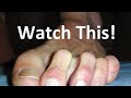 Bunion & Hammer Toe Surgery Recovery Tips in 2 minutes!