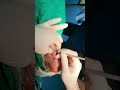 Tendoachiles Contractures release | Multiple Zigzag Tendinotomies | Adamya Hospital Videos