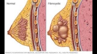 العقد الحميدة في الثدي .. أنواعها و علاجها و الوقاية منها .. معلومات لاول مرة