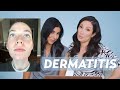 Perioral Dermatitis and Acne Skincare Routine for Jessie!