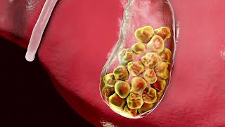 Our specialist explains modern laparoscopic treatment for gallbladder disease.
