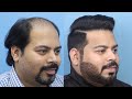 Patient Testimonial - Norwood Grade 5 baldness, 4596 grafts and a 15-month update at Eugenix.