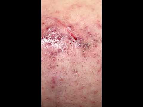 Video Mụn Dị Ứng Mỹ Phẩm - allergic acne - youtube