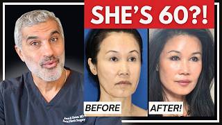 INCREDIBLE 60-Year-Old Facelift Before & After - Must-See Analysis by Facial Plastic Surgeon