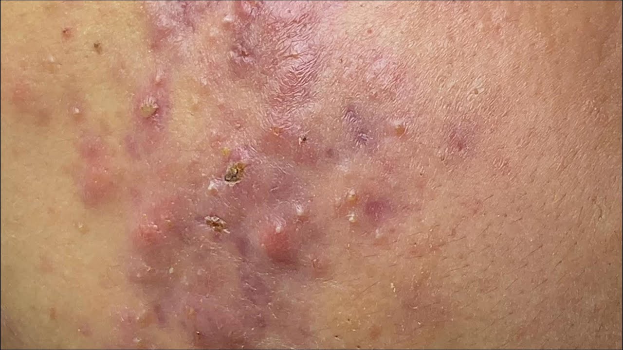 Acne Treament Under The Skin #040