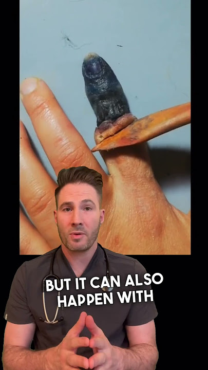 Finger Dry Gangrene 😳