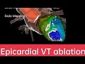 Epicardial vt ablation  dr martin  lucas  epicardialvt vtablation carto