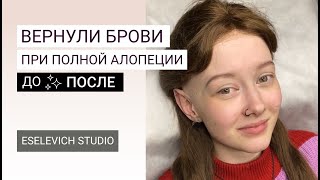 Тотальная алопеция. Перманент бровей при алопеции. Бесплатный перманент.