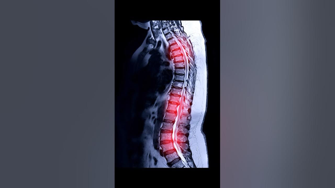 do-mris-show-back-pain-youtube