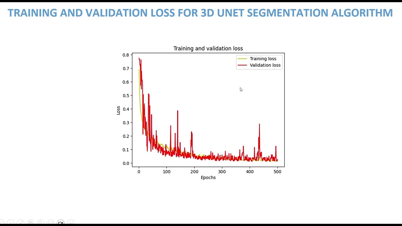 NeuroSight 3D: Elevating Glioma Segmentation and Grading with Attention-Guided AI
