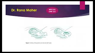 Shoulder dystocia ✅✅✅