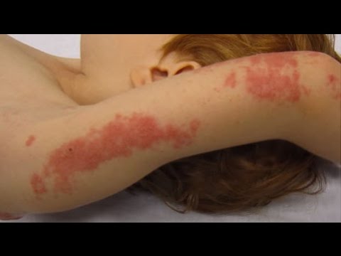 Herpes en la espalda como se contagia Herpes en la espalda como se contagia