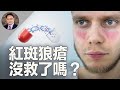 紅斑狼瘡 不死的癌症 揭秘誘發原因 分享自救指南 紅斑狼瘡 不死的癌症 揭秘誘發原因 分享自救指南