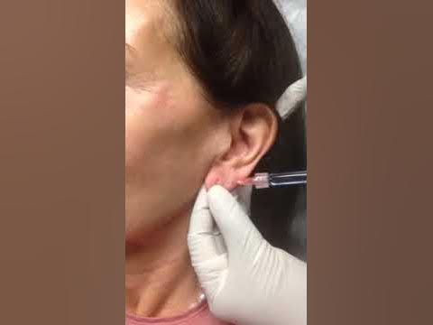 How to Use slickfix Ear Lobe Support Patches !! 