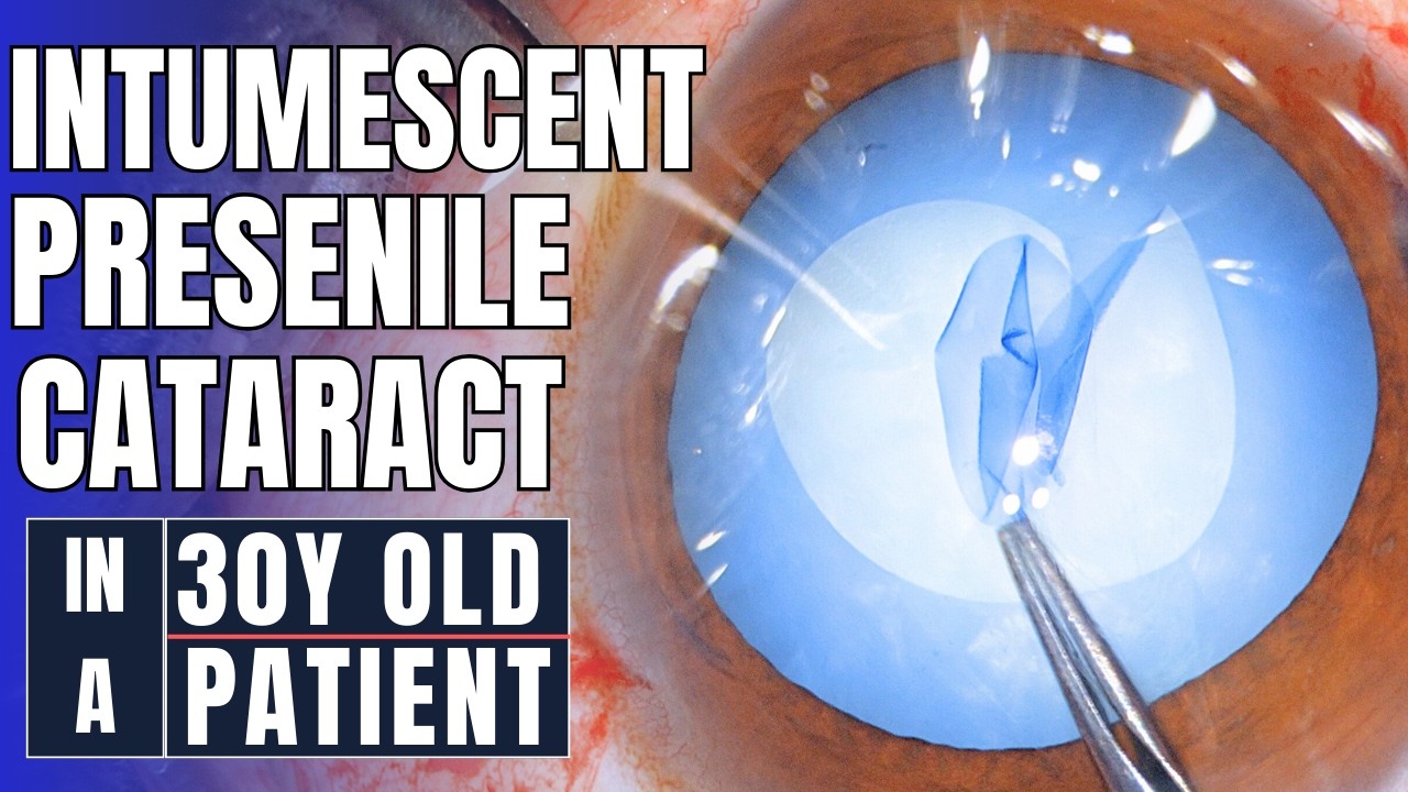 Presenile intumescent cataract, Rhexis challenges & Secret to achieve ...