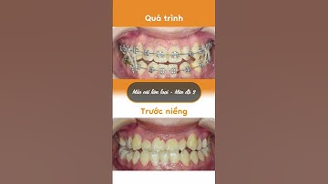 Hành trình LỘT XÁC nhờ niềng răng của Khánh Ngọc