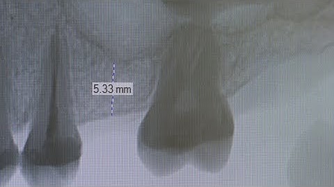 Osteotome Internal Sinus-lift Procedure