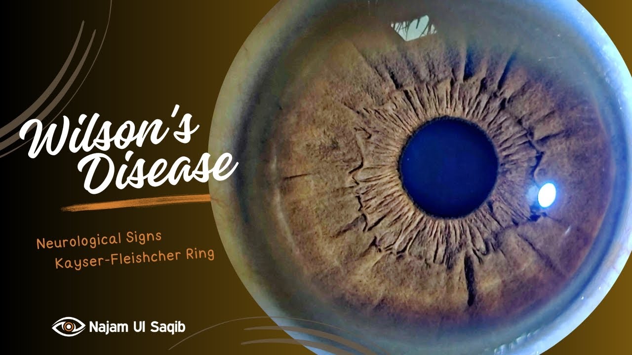 Is blinking of the eyes affected in extrapyramidal disorders? An  interesting observation in a patient with Wilson disease | BMJ Case Reports