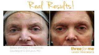Electrik Image Spa - Sun Spot Removal - Three Form Me Laser Skin Resurfacing