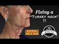 72 yo "Turkey Neck" Lift - Re-Tightening the Neck | Aesthetic Minutes #Necklift