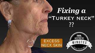 72 yo 'Turkey Neck' Lift  ReTightening the Neck | Aesthetic Minutes #Necklift