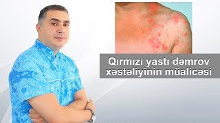 Qırmızı yastı dəmrov xəstəliyinin müalicəsi