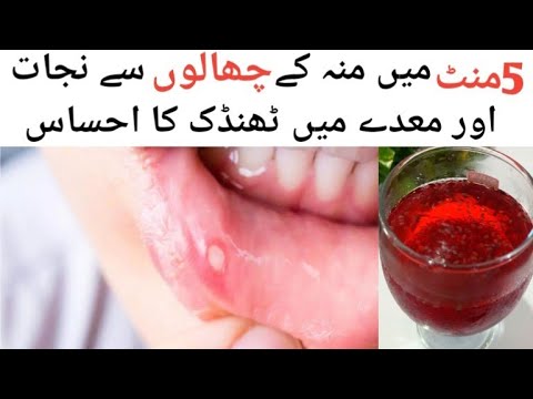 muh ke chhale ka ilaaj | home remedies for mouth ulcers in hindi | 5 منٹ میں منہ کے چھالوں سے نجات