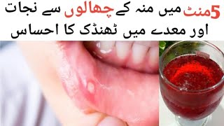 muh ke chhale ka ilaaj | home remedies for mouth ulcers in hindi | 5 منٹ میں منہ کے چھالوں سے نجات