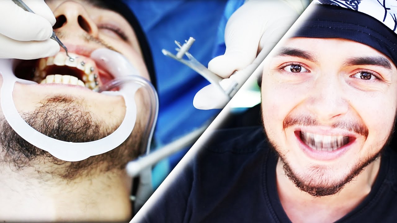 JE MET L'APPAREIL DENTAIRE !!!