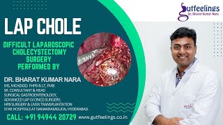 Laparoscopic cholecystectomy (Gall Bladder Removal) Surgery | performed  by Dr Bharat Kumar Nara