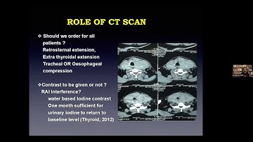 Interesting Case Series 02 -Approach to Solitary Thyroid Nodule