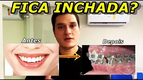 É normal a gengiva incha com o aparelho?
