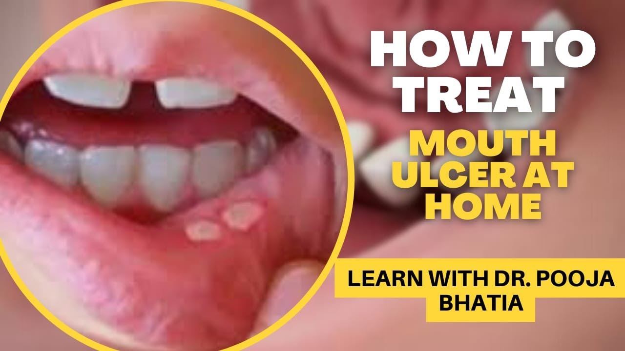how-to-treat-mouth-ulcers-at-home-home-remedies-for-ulcer-youtube