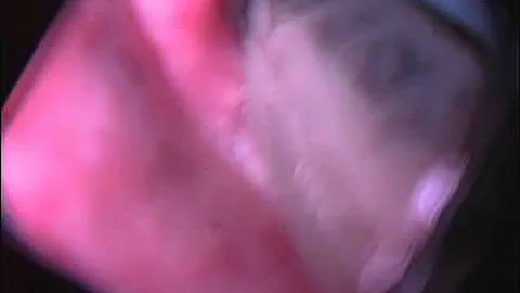 AIRTRAQ ENDO CAM + ESCHMANN INSIDE ETE
