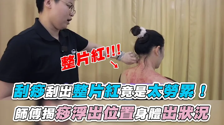 【刮痧刮出整片紅竟是太勞累！ 師傅揭痧浮出位置身體出狀況】｜老娘爽JC - 天天要聞