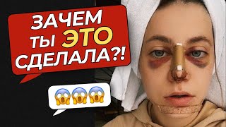 видео: Моя Ужасная Ринопластика: почему мне пришлось ДВАЖДЫ ломать нос? картинка: Моя Ужасная Ринопластика: почему мне пришлось ДВАЖДЫ ломать нос?