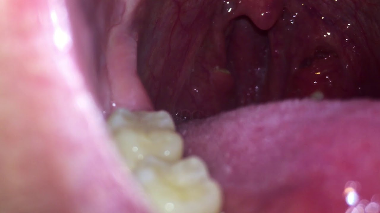 Removing My Tonsil Stones Youtube