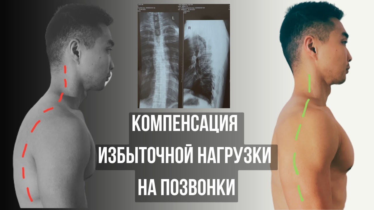 Как остановить искривления позвоночника | Компенсация избыточной ...